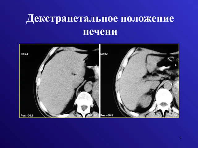 Декстрапетальное положение печени