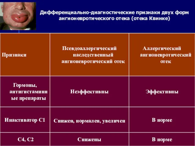 Дифференциально-диагностические признаки двух форм ангионевротического отека (отека Квинке) Инактиватор С1 Снижен, нормален Компоненты комплемента