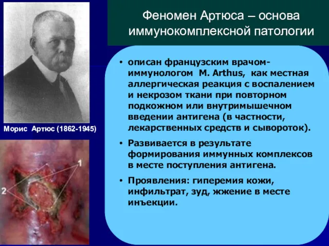 описан французским врачом-иммунологом M. Arthus, как местная аллергическая реакция с