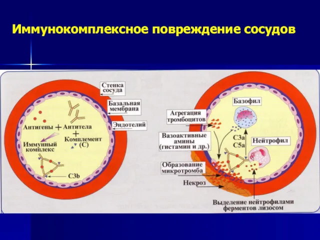 Иммунокомплексное повреждение сосудов