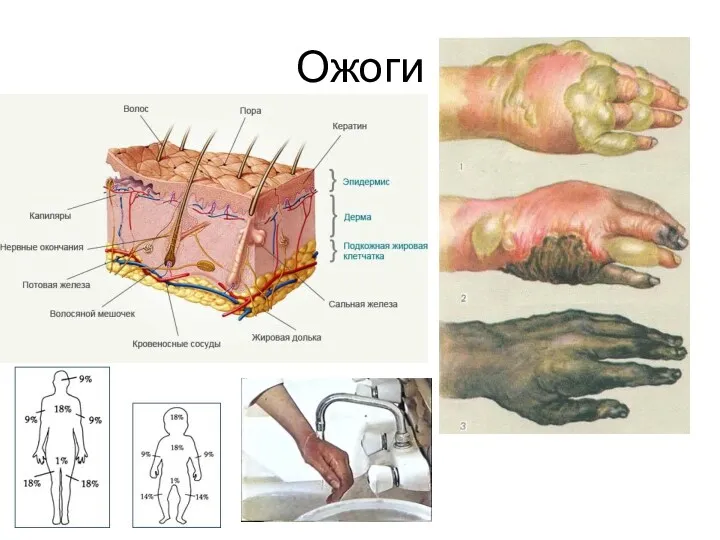 Ожоги