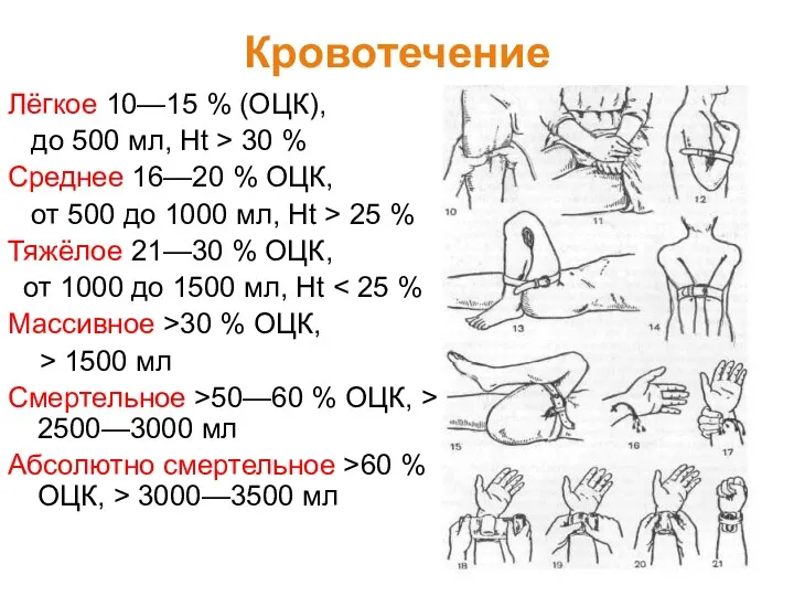 Кровотечение Лёгкое 10—15 % (ОЦК), до 500 мл, Ht >