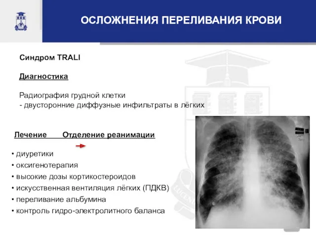 Синдром TRALI Диагностика Радиография грудной клетки - двусторонние диффузные инфильтраты