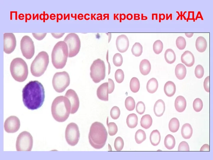 Периферическая кровь при ЖДА