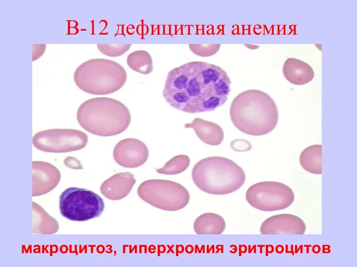 В-12 дефицитная анемия макроцитоз, гиперхромия эритроцитов