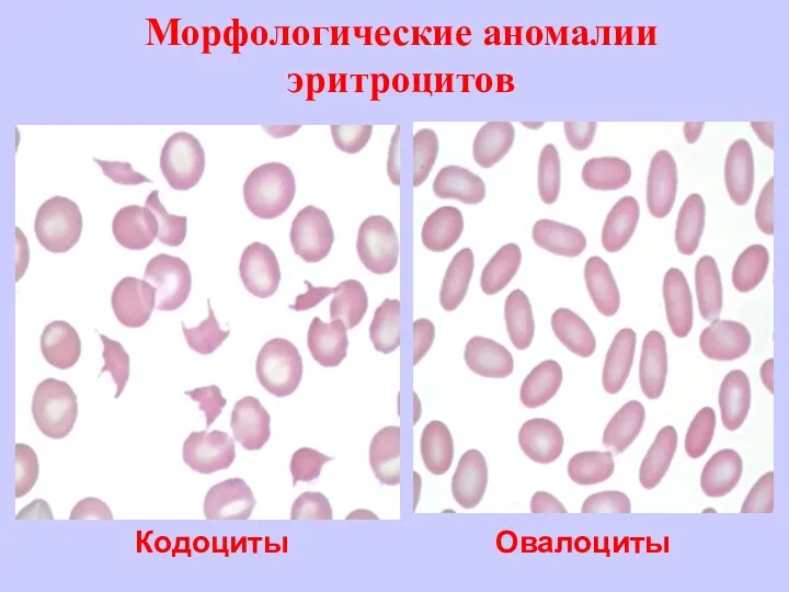 Морфологические аномалии эритроцитов Овалоциты Кодоциты