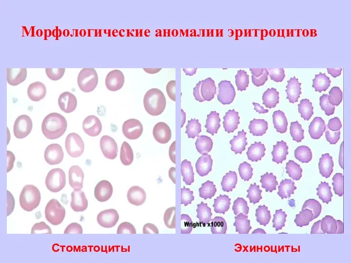 Морфологические аномалии эритроцитов Стоматоциты Эхиноциты