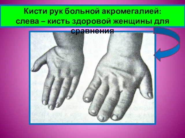 Кисти рук больной акромегалией: слева – кисть здоровой женщины для сравнения