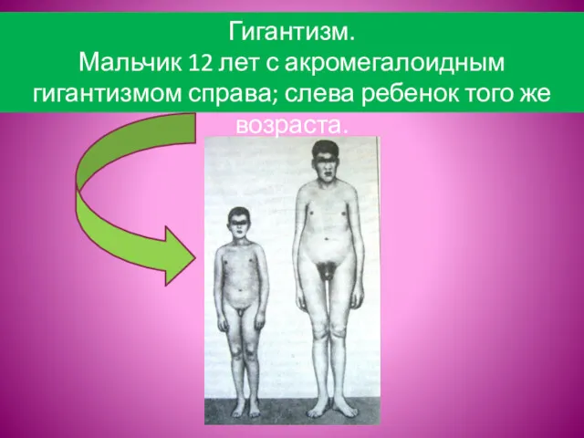 Гигантизм. Мальчик 12 лет с акромегалоидным гигантизмом справа; слева ребенок того же возраста.