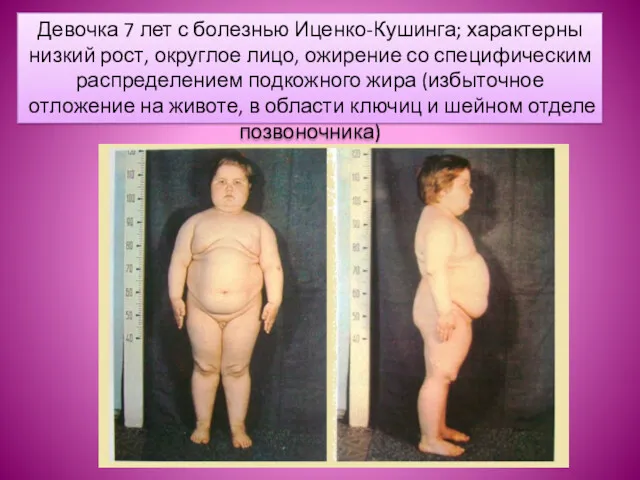 Девочка 7 лет с болезнью Иценко-Кушинга; характерны низкий рост, округлое