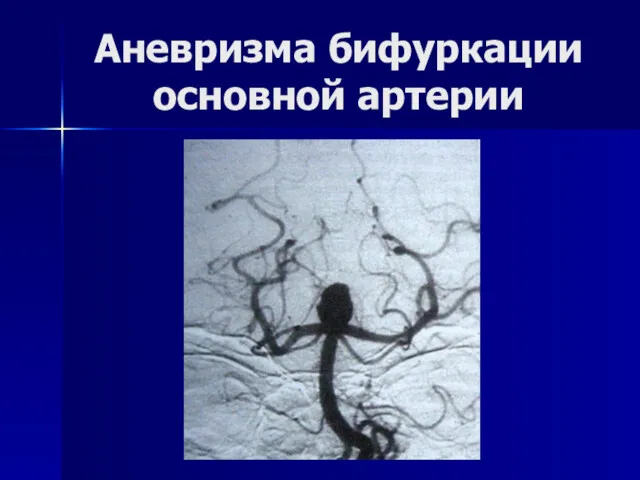 Аневризма бифуркации основной артерии