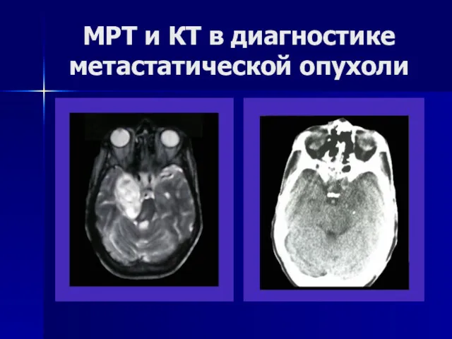 МРТ и КТ в диагностике метастатической опухоли