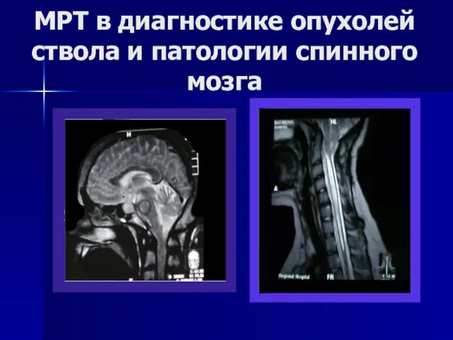 МРТ в диагностике опухолей ствола и патологии спинного мозга