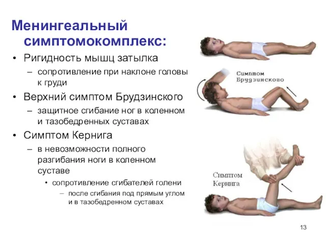 Менингеальный симптомокомплекс: Ригидность мышц затылка сопротивление при наклоне головы к