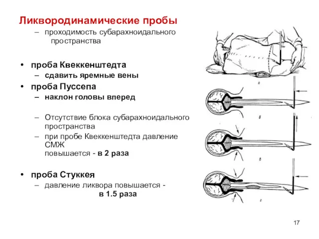 Ликвородинамические пробы проходимость субарахноидального пространства проба Квеккенштедта сдавить яремные вены