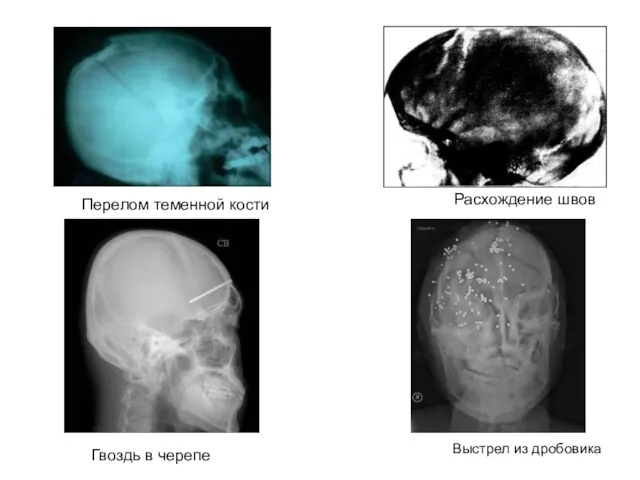 Выстрел из дробовика Перелом теменной кости Расхождение швов Гвоздь в черепе