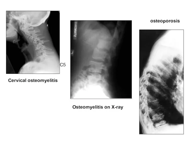 osteoporosis Cervical osteomyelitis C5 Osteomyelitis on X-ray