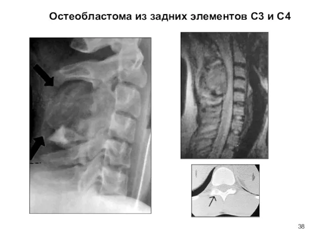 Остеобластома из задних элементов С3 и С4