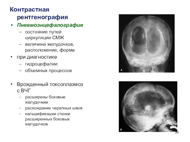 Контрастная рентгенография Пневмоэнцефалография состояние путей циркуляции СМЖ величина желудочков, расположение,