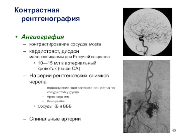 Контрастная рентгенография Ангиография контрастирование сосудов мозга кардиотраст, диодон малопроницаемы для