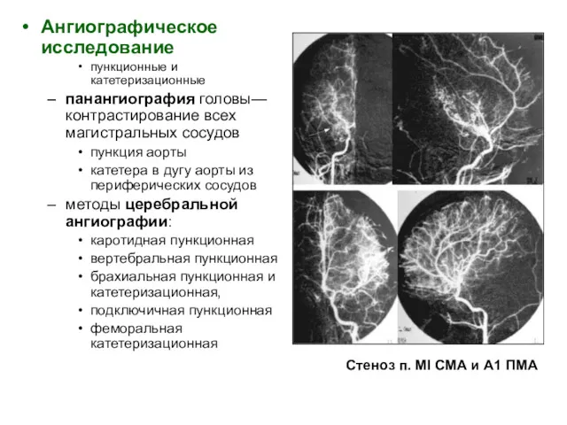 Стеноз п. Ml СМА и А1 ПМА Ангиографическое исследование пункционные