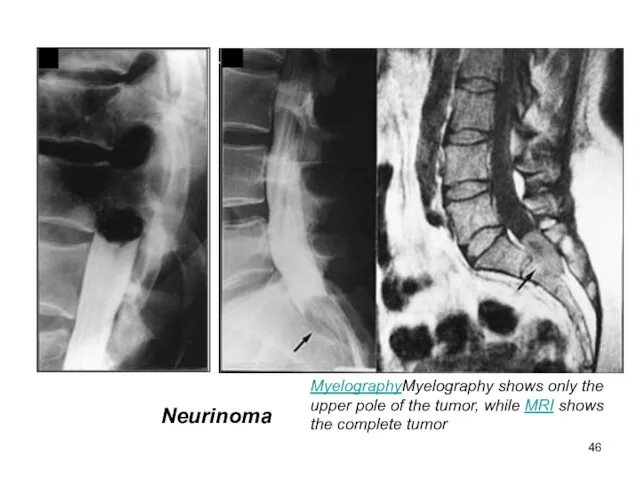 MyelographyMyelography shows only the upper pole of the tumor, while MRI shows the complete tumor Neurinoma