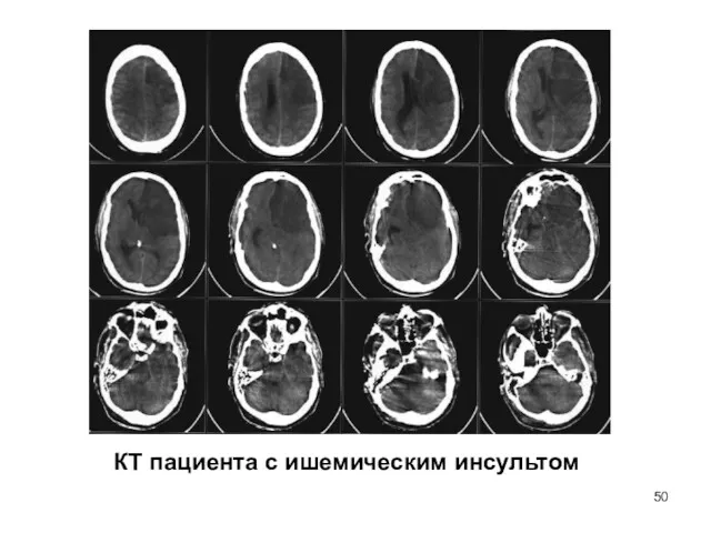 КТ пациента с ишемическим инсультом