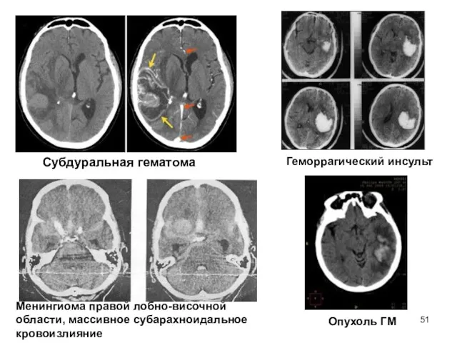 Субдуральная гематома Геморрагический инсульт Менингиома правой лобно-височной области, массивное субарахноидальное кровоизлияние Опухоль ГМ