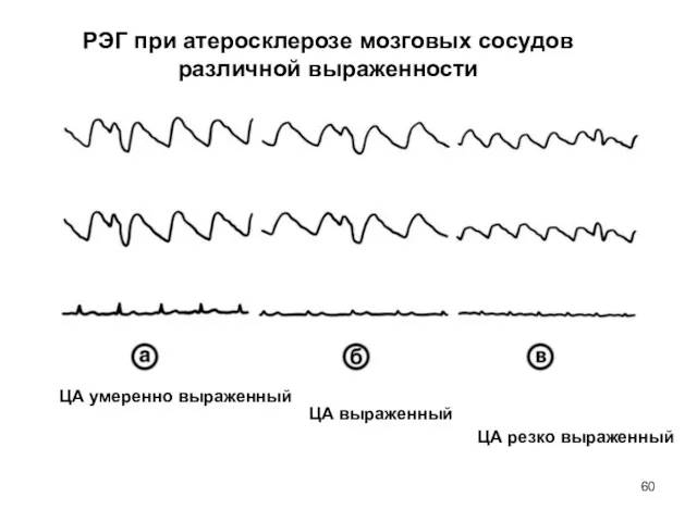 РЭГ при атеросклерозе мозговых сосудов различной выраженности ЦА умеренно выраженный ЦА выраженный ЦА резко выраженный