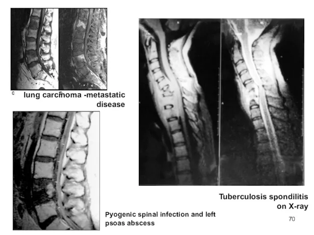Tuberculosis spondilitis on X-ray Pyogenic spinal infection and left psoas abscess lung carcinoma -metastatic disease