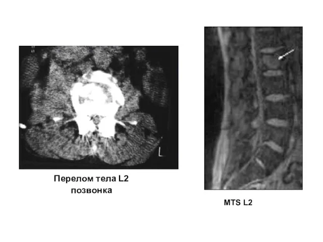 Перелом тела L2 позвонка MTS L2