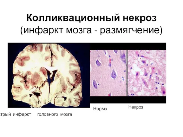Колликвационный некроз (инфаркт мозга - размягчение) Острый инфаркт головного мозга Норма Некроз