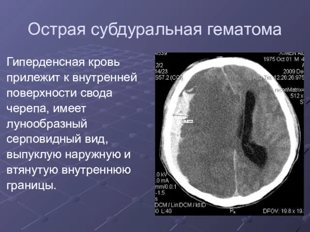 Острая субдуральная гематома Гиперденсная кровь прилежит к внутренней поверхности свода