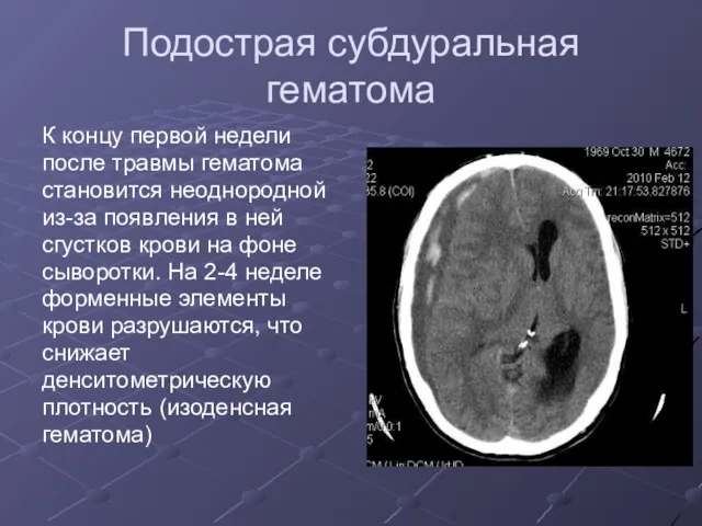 Подострая субдуральная гематома К концу первой недели после травмы гематома