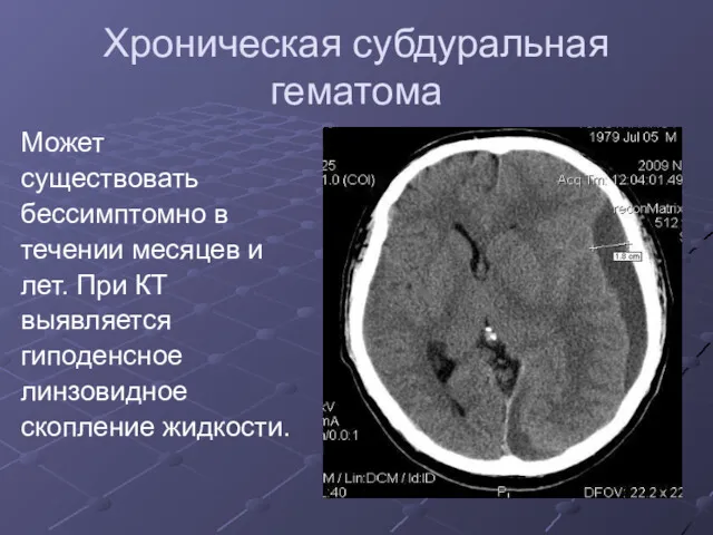 Хроническая субдуральная гематома Может существовать бессимптомно в течении месяцев и