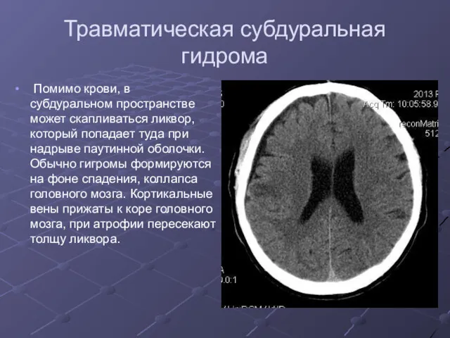 Травматическая субдуральная гидрома Помимо крови, в субдуральном пространстве может скапливаться