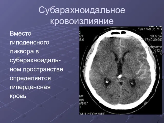 Субарахноидальное кровоизлияние Вместо гиподенсного ликвора в субарахноидаль- ном пространстве определяется гиперденсная кровь