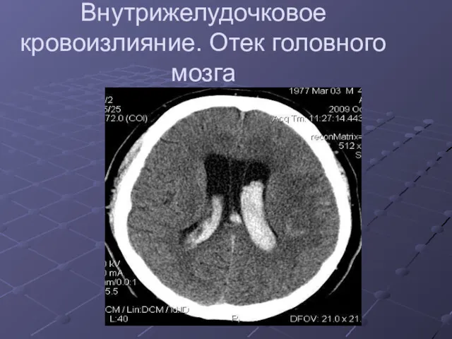 Внутрижелудочковое кровоизлияние. Отек головного мозга