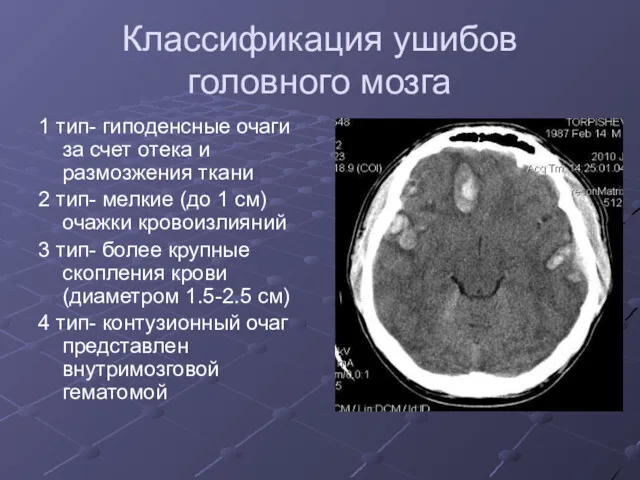 Классификация ушибов головного мозга 1 тип- гиподенсные очаги за счет