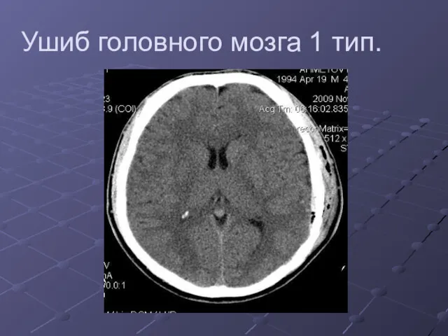 Ушиб головного мозга 1 тип.