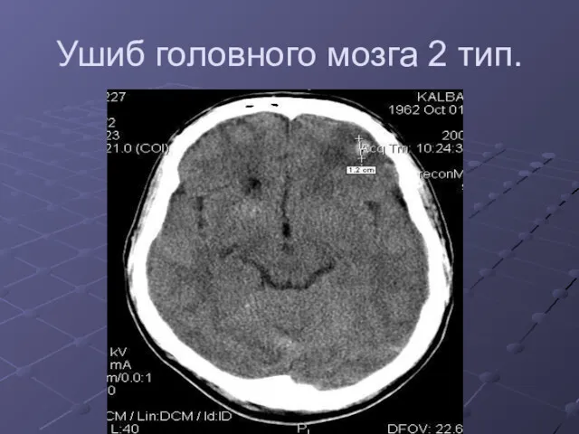 Ушиб головного мозга 2 тип.