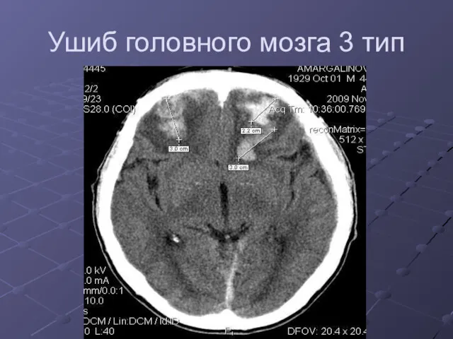 Ушиб головного мозга 3 тип