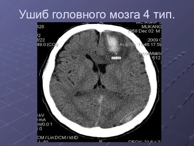 Ушиб головного мозга 4 тип.