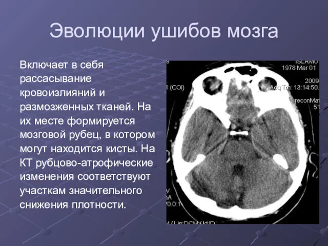 Эволюции ушибов мозга Включает в себя рассасывание кровоизлияний и размозженных