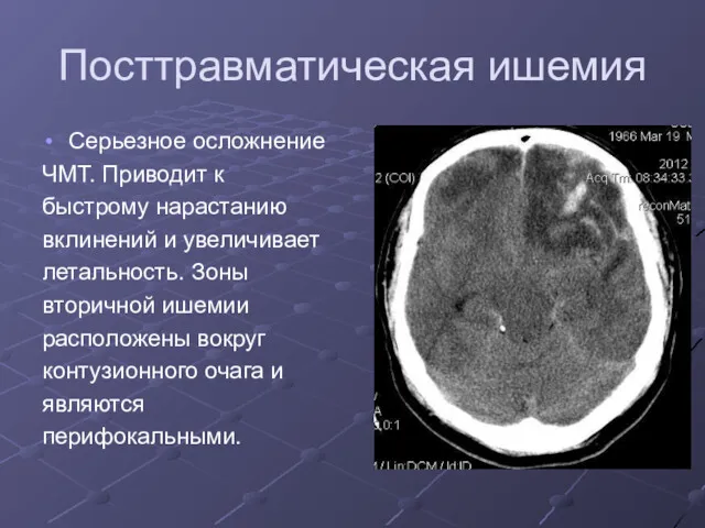 Посттравматическая ишемия Серьезное осложнение ЧМТ. Приводит к быстрому нарастанию вклинений