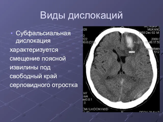 Виды дислокаций Субфальсиальная дислокация характеризуется смещение поясной извилины под свободный край серповидного отростка