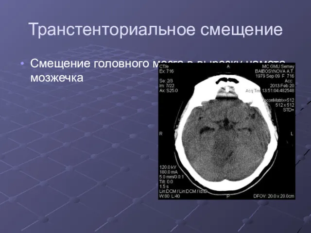 Транстенториальное смещение Смещение головного мозга в вырезку намета мозжечка