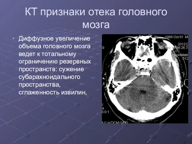 КТ признаки отека головного мозга Диффузное увеличение объема головного мозга