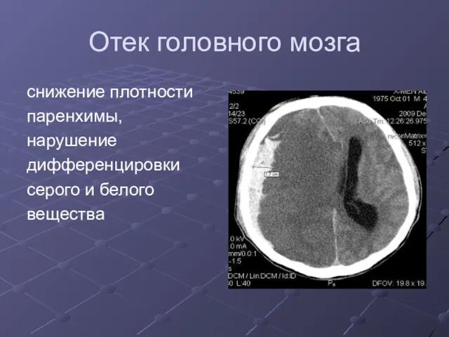 Отек головного мозга снижение плотности паренхимы, нарушение дифференцировки серого и белого вещества