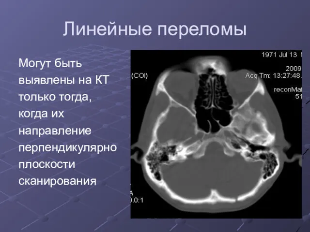 Линейные переломы Могут быть выявлены на КТ только тогда, когда их направление перпендикулярно плоскости сканирования